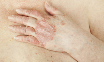 Manos de una paciente con artritis psoriásica